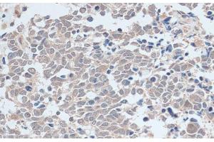 Immunohistochemistry of paraffin-embedded Human lung cancer using ZNF581 Polyclonal Antibody at dilution of 1:100 (40x lens). (ZNF581 Antikörper)