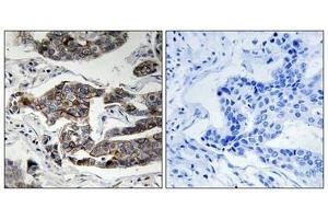 Immunohistochemical analysis of paraffin-embedded human breast carcinoma tissue using Girdin (Phospho-Ser1417) antibody (left)or the same antibody preincubated with blocking peptide (right).