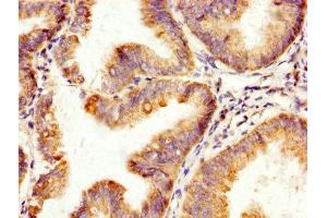IHC image of ABIN7170472 diluted at 1:200 and staining in paraffin-embedded human endometrial cancer performed on a Leica BondTM system. (SPA17 Antikörper  (AA 1-146))