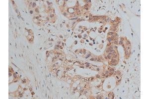 ABIN6266511 at 1/50 staining human colon cancer tissue sections by IHC-P. (E-cadherin Antikörper  (C-Term))