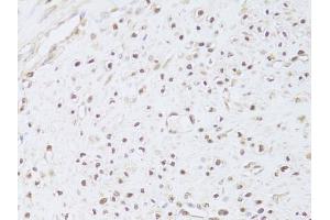 Immunohistochemistry of paraffin-embedded human leiomyoma of uterus using FKBP4 Antibody (ABIN5973289) at dilution of 1/100 (40x lens). (FKBP4 Antikörper)