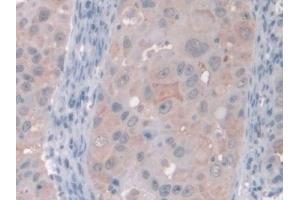 Detection of GAMT in Human Breast cancer Tissue using Polyclonal Antibody to Guanidinoacetate-N-Methyltransferase (GAMT) (GAMT Antikörper  (AA 64-236))