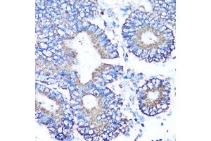 Immunohistochemistry of paraffin-embedded human colon carcinoma using MMP16 antibody (ABIN6132356, ABIN6143906, ABIN6143907 and ABIN6214654) at dilution of 1:100 (40x lens).