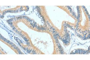 Immunohistochemistry of paraffin-embedded Human colon cancer using ASGR1 Polyclonal Antibody at dilution of 1:50 (Asialoglycoprotein Receptor 1 Antikörper)
