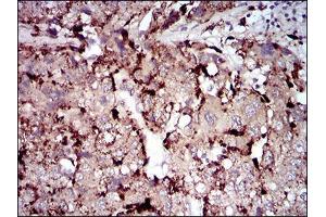Immunohistochemical analysis of paraffin-embedded liver cancer tissues using PLA2G12A mouse mAb with DAB staining. (PLA2G12A Antikörper  (AA 21-189))
