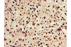 Immunohistochemistry of paraffin-embedded human glioma using ABIN7151635 at dilution of 1:100 (Nth Endonuclease III-Like 1 (NTHL1) (AA 31-312) Antikörper)
