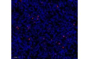 Immunofluorescence of paraffin embedded human colon cancer using c-caspase3 (ABIN7073336) at dilution of 1:500 (200x lens) (Caspase 3 Antikörper  (cleaved))