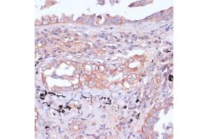 Immunohistochemistry of paraffin-embedded human lung cancer using RPL32 antibody (ABIN6129104, ABIN6147138, ABIN6147139 and ABIN6216824) at dilution of 1:100 (40x lens). (RPL32 Antikörper  (AA 1-135))