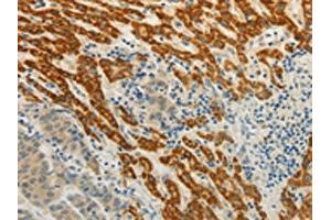 The image on the left is immunohistochemistry of paraffin-embedded Human liver cancer tissue using ABIN7190314(CMTM7 Antibody) at dilution 1/30, on the right is treated with synthetic peptide. (CMTM7 Antikörper)