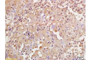 Formalin-fixed and paraffin embedded human breast carcinoma labeled with Rabbit Anti Phospho-BRCA1(Ser1189) Polyclonal Antibody, Unconjugated (ABIN756637) at 1:200 followed by conjugation to the secondary antibody and DAB staining (BRCA1 Antikörper  (pSer1189))