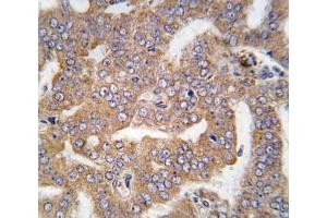 IHC analysis of FFPE human prostate carcinoma tissue stained with PAK4 antibody