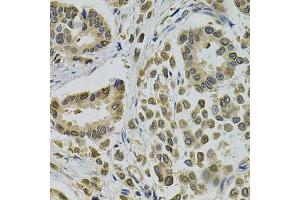 Immunohistochemistry of paraffin-embedded human breast cancer using EBAG9 Antibody. (RCAS1 Antikörper  (AA 28-213))