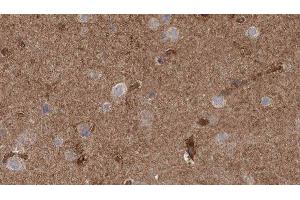 ABIN6277796 at 1/100 staining Human brain cancer tissue by IHC-P. (CLCN3 Antikörper  (N-Term))