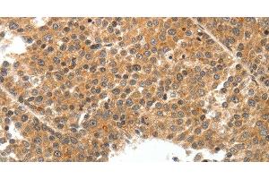 Immunohistochemistry of paraffin-embedded Human liver cancer tissue using TEK Polyclonal Antibody at dilution 1:50 (TEK Antikörper)