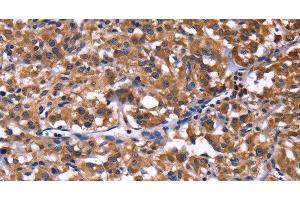Immunohistochemistry of paraffin-embedded Human thyroid cancer tissue using SELPLG Polyclonal Antibody at dilution 1:50 (SELPLG Antikörper)