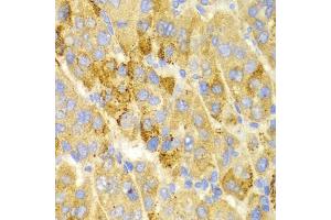 Immunohistochemistry of paraffin-embedded human liver cancer using LAMP3 antibody (ABIN5971497) at dilution of 1/100 (40x lens). (LAMP3 Antikörper)