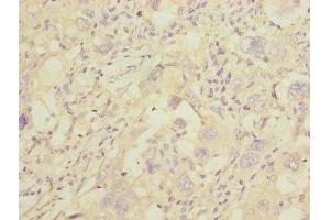 Immunohistochemistry of paraffin-embedded human liver cancer using ABIN7154068 at dilution of 1:100 (GGTLC2 Antikörper  (AA 1-218))