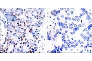 Immunohistochemistry analysis of paraffin-embedded human breast carcinoma tissue, using c-Jun (Ab-91) Antibody. (C-JUN Antikörper  (AA 58-107))