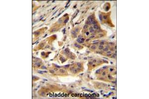 RBCK1 (UBCE7IP3) Antibody immunohistochemistry analysis in formalin fixed and paraffin embedded human bladder carcinoma followed by peroxidase conjugation of the secondary antibody and DAB staining. (RBCK1 Antikörper  (N-Term))