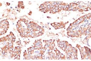 Immunohistochemistry of paraffin-embedded Human thyroid cancer using FRMD6 Polyclonal Antibody at dilution of 1:100 (40x lens).