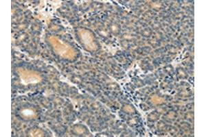 The image on the left is immunohistochemistry of paraffin-embedded Human thyroid cancer tissue using ABIN7189588(ABCC12 Antibody) at dilution 1/10, on the right is treated with synthetic peptide. (ABCC12 Antikörper)