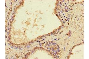 Immunohistochemistry of paraffin-embedded human prostate cancer using ABIN7162746 at dilution of 1:100 (PTCD2 Antikörper  (AA 153-388))