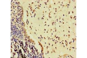 Immunohistochemistry of paraffin-embedded human lung cancer using ABIN7166936 at dilution of 1:100
