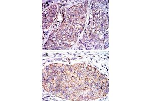 Immunohistochemical analysis of paraffin-embedded human lung cancer (A) and human kidney cancer (B) tissue using SERPINE1 monoclonal antobody, clone 1D5  with DAB staining. (PAI1 Antikörper)