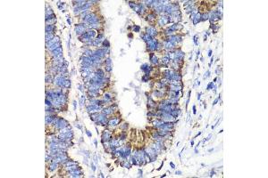 Immunohistochemistry of paraffin-embedded human colon carcinoma using RALB antibody (ABIN1682468, ABIN5664619, ABIN5664621 and ABIN6220484) at dilution of 1:100 (40x lens).