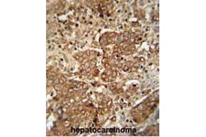 APCS antibody (C-term) immunohistochemistry analysis in formalin fixed and paraffin embedded human hepatocarcinoma followed by peroxidase conjugation of the secondary antibody and DAB staining.