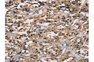 The image on the left is immunohistochemistry of paraffin-embedded Human thyroid cancer tissue using ABIN7128926(CGA Antibody) at dilution 1/65, on the right is treated with fusion protein. (CGA Antikörper)