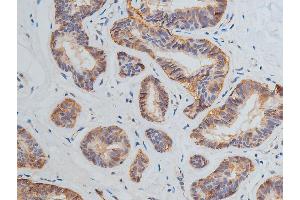 ABIN6269228 at 1/200 staining human breast cancer tissue sections by IHC-P. (VEGFR2/CD309 Antikörper)