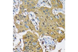 Immunohistochemistry of paraffin-embedded human lung cancer using RPB3/POLR2C Rabbit mAb (ABIN7269458) at dilution of 1:100 (40x lens). (POLR2C Antikörper)
