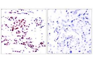 Immunohistochemical analysis of paraffin- embedded human breast carcinoma tissue using STAT5A (Ab-780) antibody (E021049). (STAT5A Antikörper)