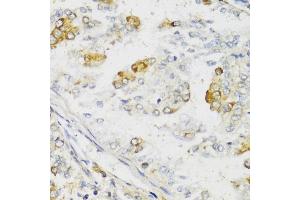 Immunohistochemistry of paraffin-embedded human uterine cancer using MLKL antibody (ABIN6134395, ABIN6143882, ABIN6143886 and ABIN6217454) at dilution of 1:100 (40x lens). (MLKL Antikörper  (C-Term))