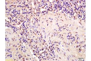Formalin-fixed and paraffin embedded human gastric carcinoma labeled with Anti-CPSF4/CPSF30 Polyclonal Antibody, Unconjugated (ABIN1386751) at 1:200 followed by conjugation to the secondary antibody and DAB staining (CPSF4 Antikörper  (AA 81-180))