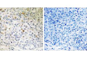 Peptide - +Immunohistochemistry analysis of paraffin-embedded human breast carcinoma tissue using CALML5 antibody.