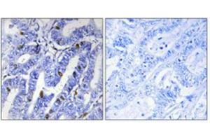 Immunohistochemical staining of human colon cancer (left). (PRKAR2B Antikörper  (pSer113))