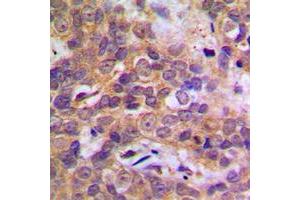 Immunohistochemical analysis of p38 staining in human breast cancer formalin fixed paraffin embedded tissue section. (MAPK14 Antikörper  (Center))