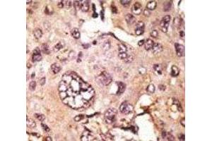IHC analysis of FFPE human hepatocarcinoma tissue stained with the TAU antibody (tau Antikörper  (AA 677-707))
