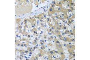 Immunohistochemistry of paraffin-embedded human liver cancer using XPC antibody (ABIN5974562) at dilution of 1/100 (40x lens). (XPC Antikörper)