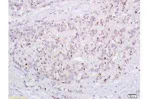 Formalin-fixed and paraffin embedded human endometrium tissue labeled with Anti-P73 Polyclonal Antibody, Unconjugated (ABIN675279) followed by conjugation to the secondary antibody and DAB staining (Tumor Protein p73 Antikörper  (AA 501-631))