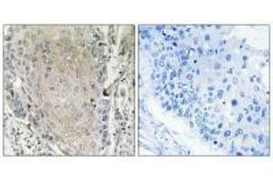 Immunohistochemistry analysis of paraffin-embedded human lung carcinoma tissue using CBLN3 antibody. (CBLN3 Antikörper)