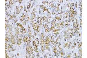 Immunohistochemistry of paraffin-embedded Human colon carcinoma using Aconitase 2  antibody (ABIN1678537, ABIN3017991, ABIN3017992 and ABIN6220329) at dilution of 1:100 (40x lens). (ACO2 Antikörper  (AA 501-780))