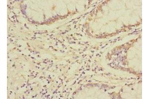 Immunohistochemistry of paraffin-embedded human colon cancer using ABIN7174422 at dilution of 1:100 (UBAP1 Antikörper  (AA 1-300))