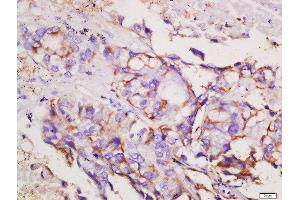 Formalin-fixed and paraffin embedded human lung carcinoma labeled with Rabbit Anti-CCR6/CD196 Polyclonal Antibody, Unconjugated  at 1:200 followed by conjugation to the secondary antibody and DAB staining (CCR6 Antikörper  (AA 201-300))