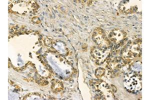 FAS Mouse Monoclonal Antibody at 1/100 staining human ovarian cancer by IHC-P.