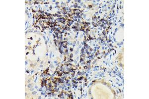 Immunohistochemistry of paraffin-embedded human thyroid cancer using PIK3CG Rabbit pAb (ABIN6130600, ABIN6145638, ABIN6145639 and ABIN6222396) at dilution of 1:100 (40x lens). (PIK3 gamma Antikörper  (AA 1-200))