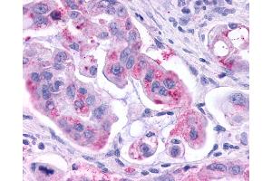 Anti-KISS1R / GPR54 antibody IHC of human Pancreas, Carcinoma. (KISS1R Antikörper  (N-Term))