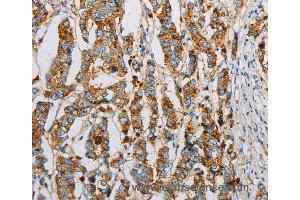 Immunohistochemistry of Human breast cancer using IFITM3 Polyclonal Antibody at dilution of 1:20 (IFITM3 Antikörper)